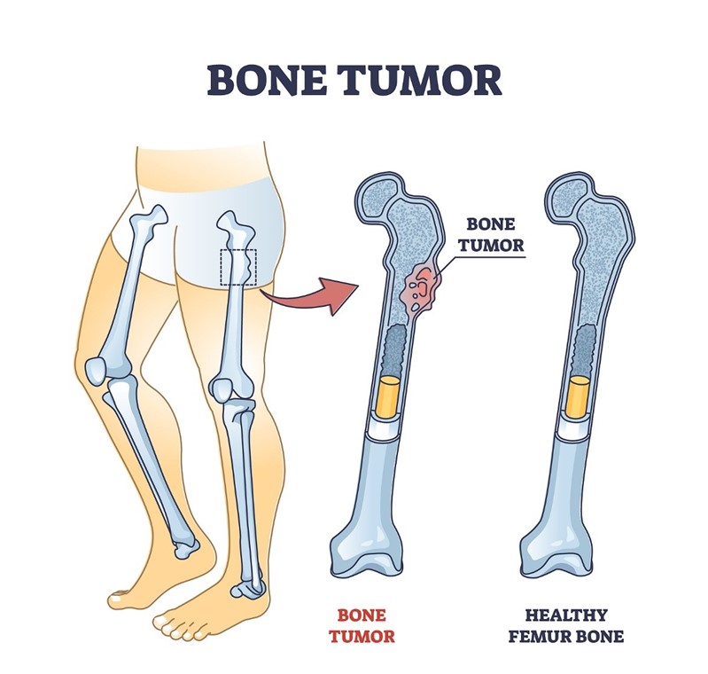  Bone Tumor